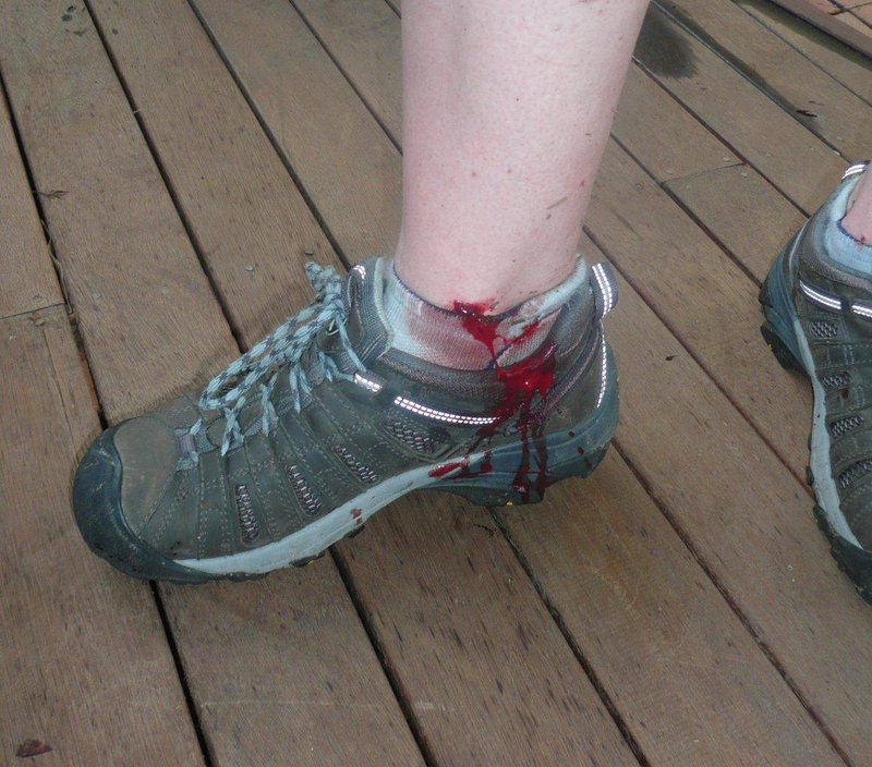 leech bite.jpg